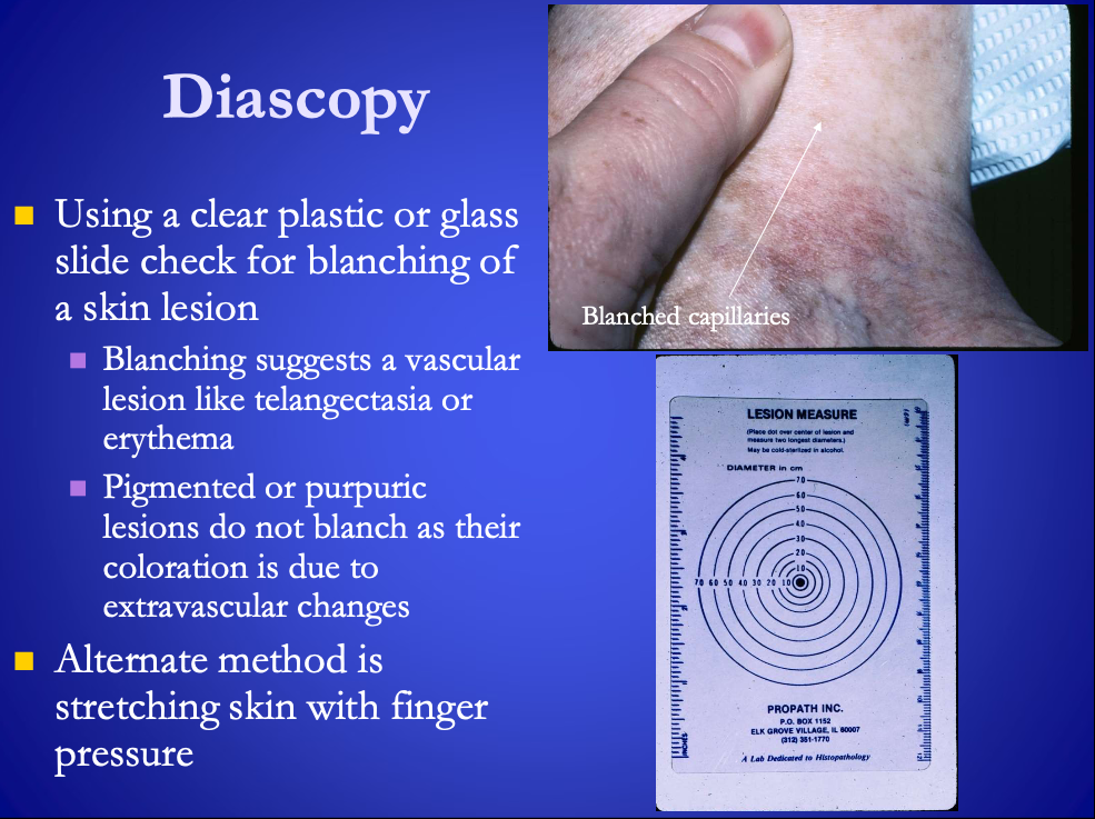 <p><span>Diascopy</span> – checking for blanching of a skin lesion</p><ul><li><p>Blanching (turning pale) suggest <span><strong>[...]</strong></span> lesion like telangectasia or erythema</p></li><li><p>No blanching if pigmented or purpuric (rash of purple spots) because that’s due to extravascular changes&nbsp;</p></li></ul><p></p>