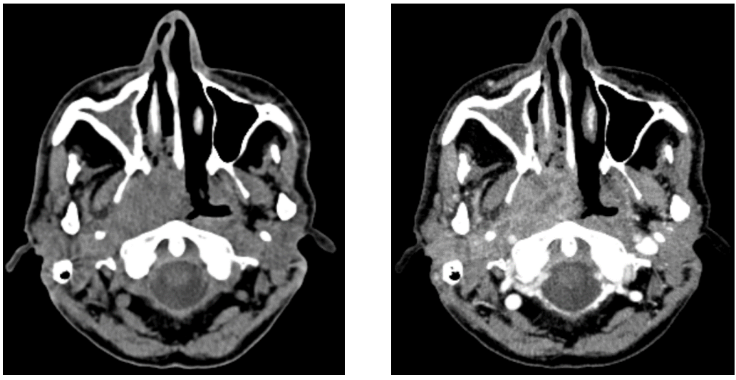 <p>What does this CT image show?</p>