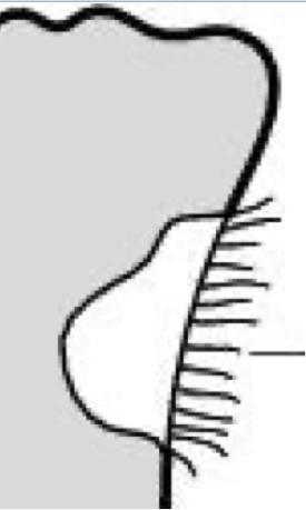 <p>what type of abnormal periosteum is this?</p>