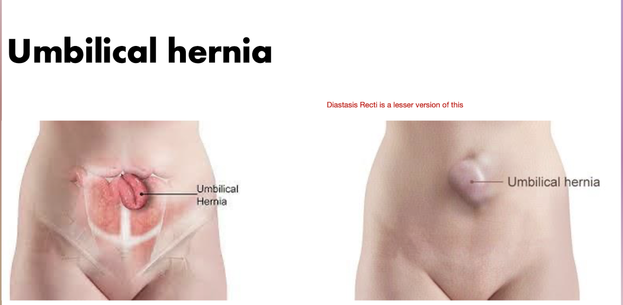<p>Umbilical Hernia</p>