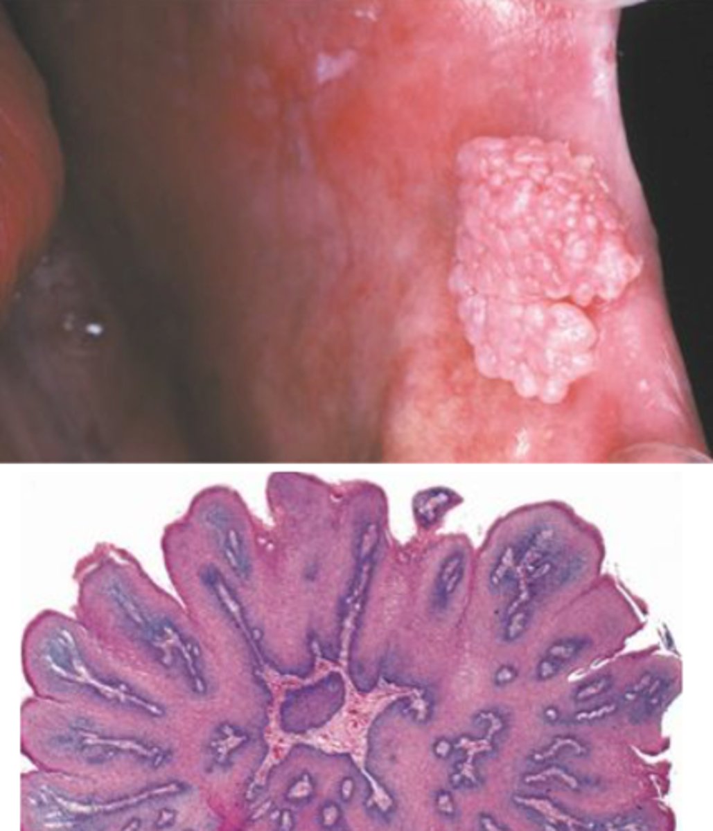 <p>squamous papilloma</p>