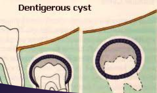 <p>Where might you find dentigerous cyst?</p>