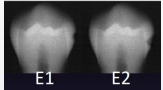 <p>caries DO NOT extend to DEJ; most often defined at extending ½ through enamel </p>