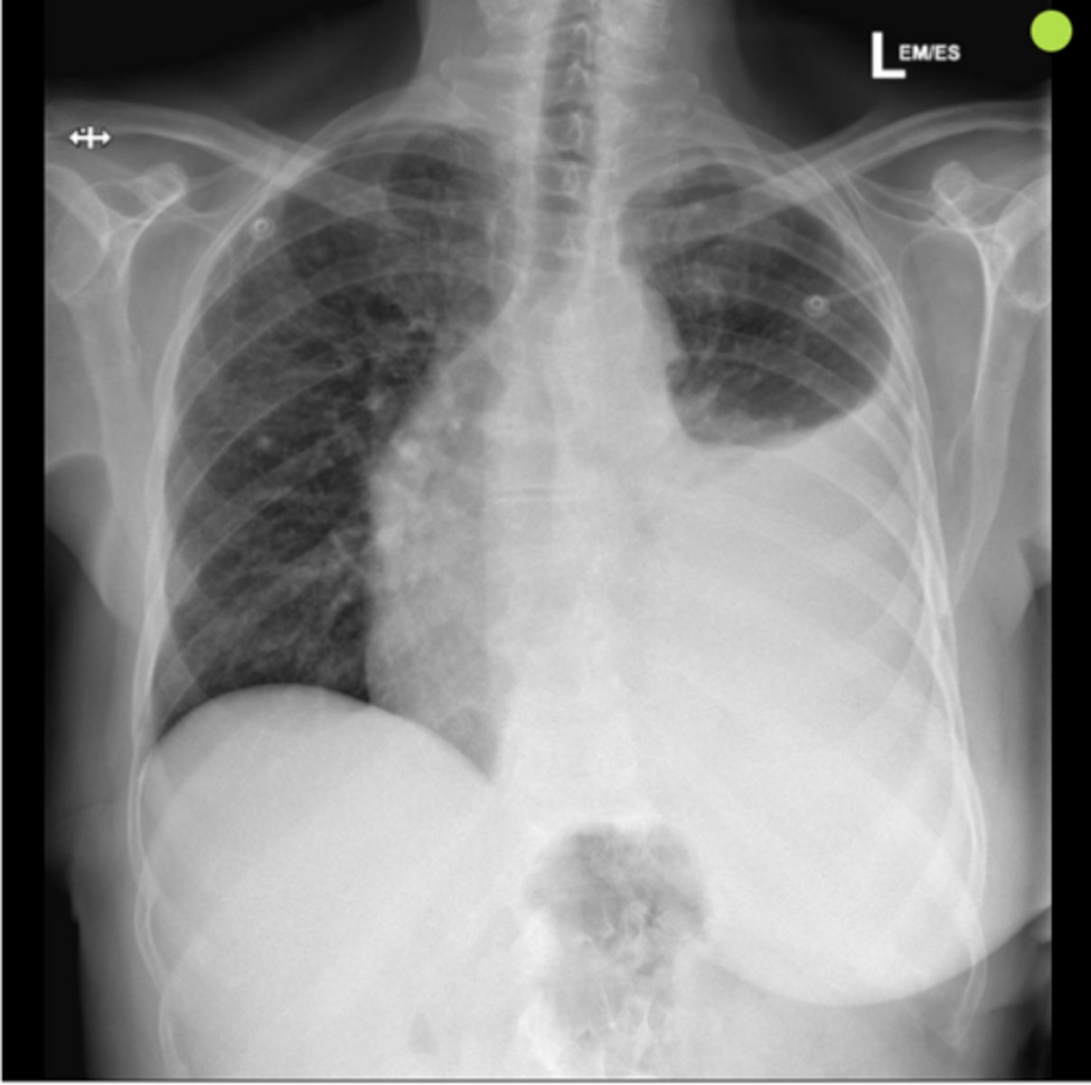 <p>pleural effusion</p>