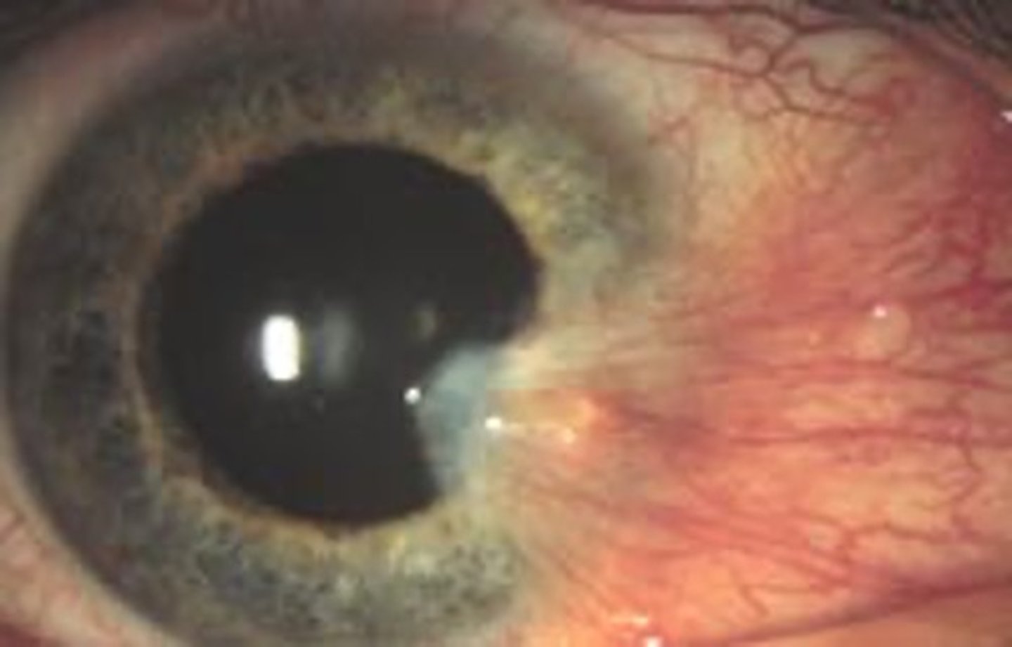 <p>overgrowth of bulbar conjunctiva (benign)</p><p>- thickening of the epithelial tissue</p><p>- can affect vision -> tx. surgical excision</p>