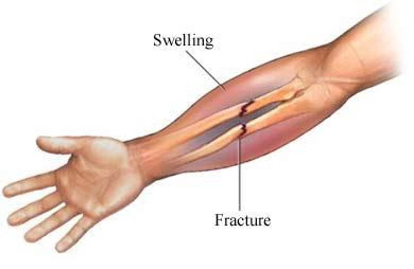<p>skin is unbroken. Injured bone causes pain and tenderness, loss of function, deformity, unnatural movement, swelling, bruising, grating sensation</p>