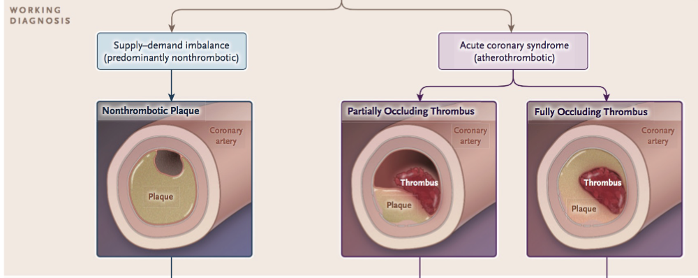 Non-thrombotic plaque rupture, partially occluding thrombus, & fully occluding thrombus.
