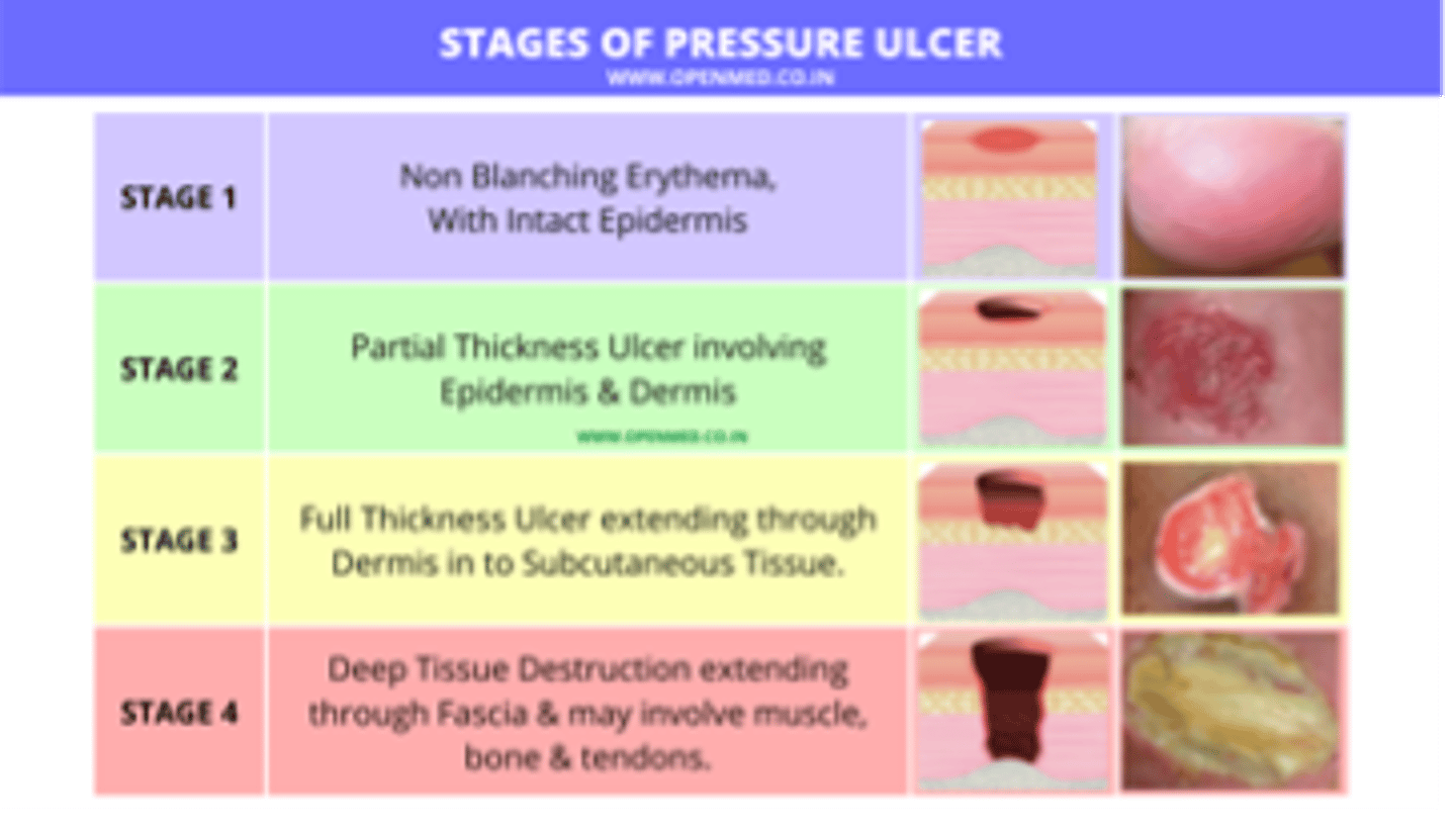 <p>Stage II</p><p>Clinically, the ulcer is manifested as a blister, abrasion, or shallow crater</p>