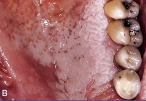 <p>what is the management of this lesion</p>
