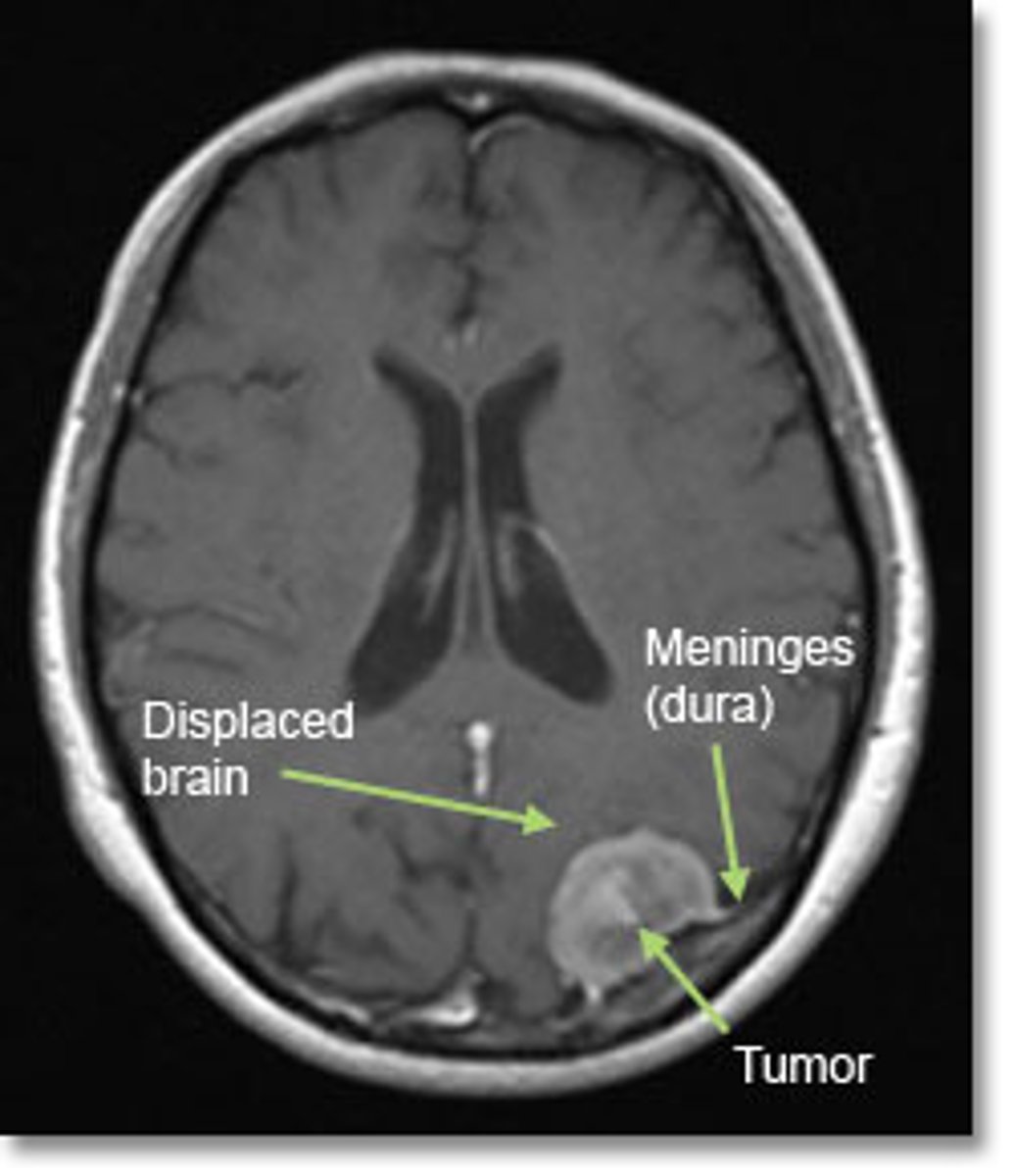 <p>tumors that grow between the meninges</p><p>- slow growing</p><p>- capsules</p><p>- pressure causes seizures</p><p>- surgery + drugs to reduce tumor</p>