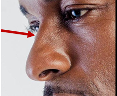 <p>dorsum nasi: bridge</p>