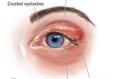 <p>PP: chronic inflammation of eyelids<br>at base of hair follicles</p><p>E: s. aureus<br>malasezzia→scaling seborrheic blepharitis</p>