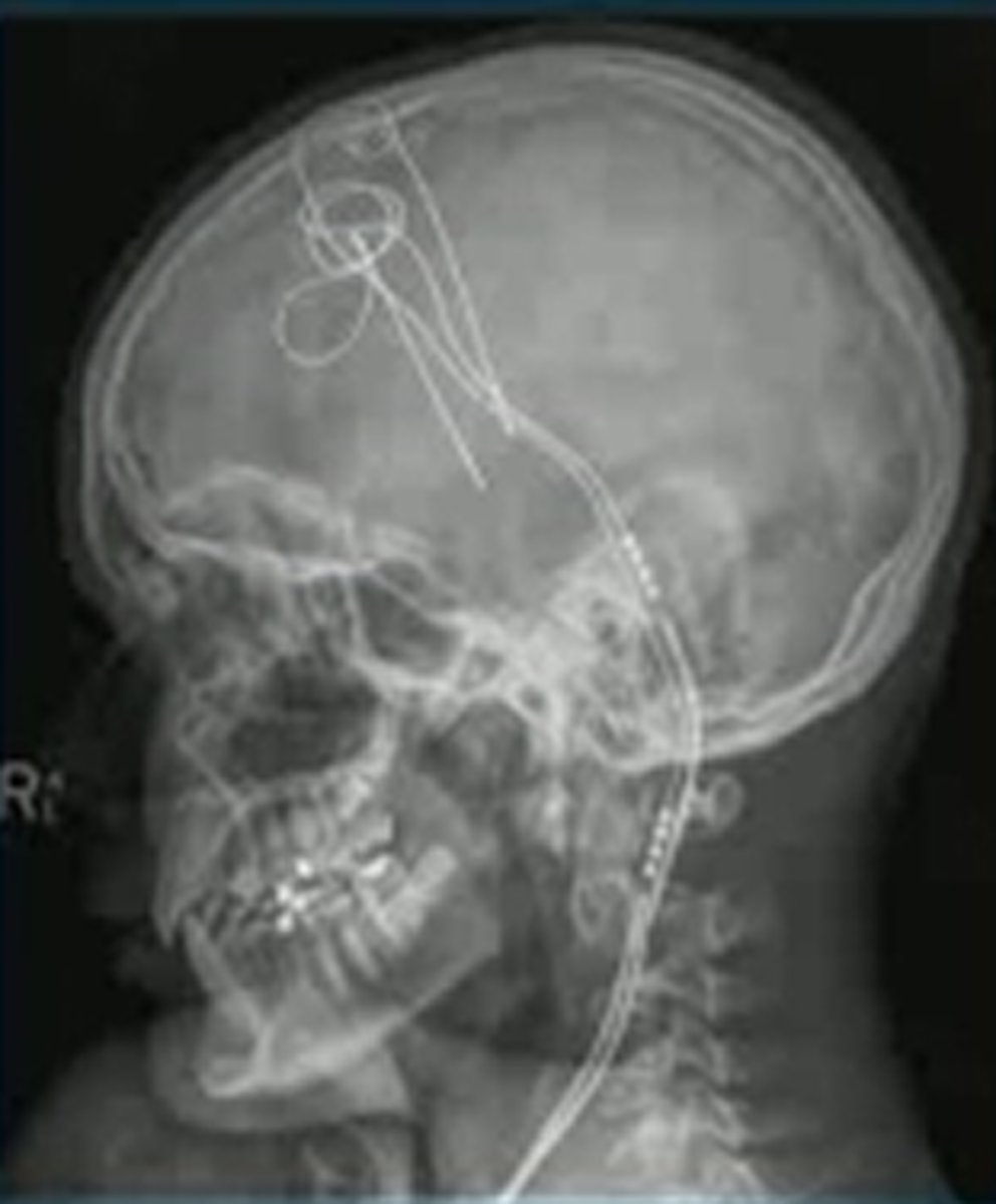 <p>stimulation = increase or decrease activity in the brain</p><p>- electrophysiology = techniques that are used to try to read the electrical signals of the brain</p>