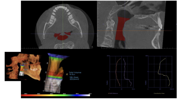 <p>Obstructive sleep apnea (OSA); severe OSA patients had significantly narrower cross-sectional area at uvula, more inferiorly positioned hyoid bone, and thicker soft palate</p>