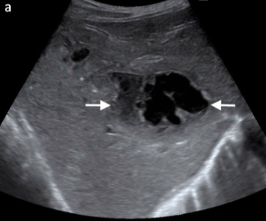 <p>Benign liver lesion</p>