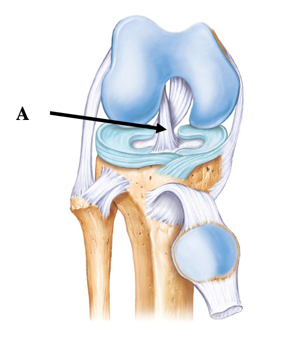 <p>Arrow A is pointing to the ____ on the knee joint (right knee)</p><p></p><p>A. Fibular collateral ligament</p><p>B. Anterior cruciate ligament</p><p>C. Posterior cruciate ligament</p><p>D. Tibial collateral ligament</p>