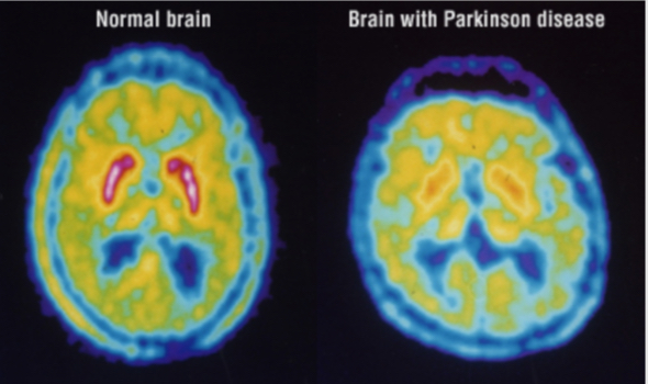 <ul><li><p>it uses 2-DG as a measure of neural activity, but has been replaced by the fMRI </p></li><li><p>It is used with other radioactive tracers</p></li><li><p>It is uses to medausde changes in the expression levels of neurotransmitter receptors across weeks</p></li></ul><p></p>