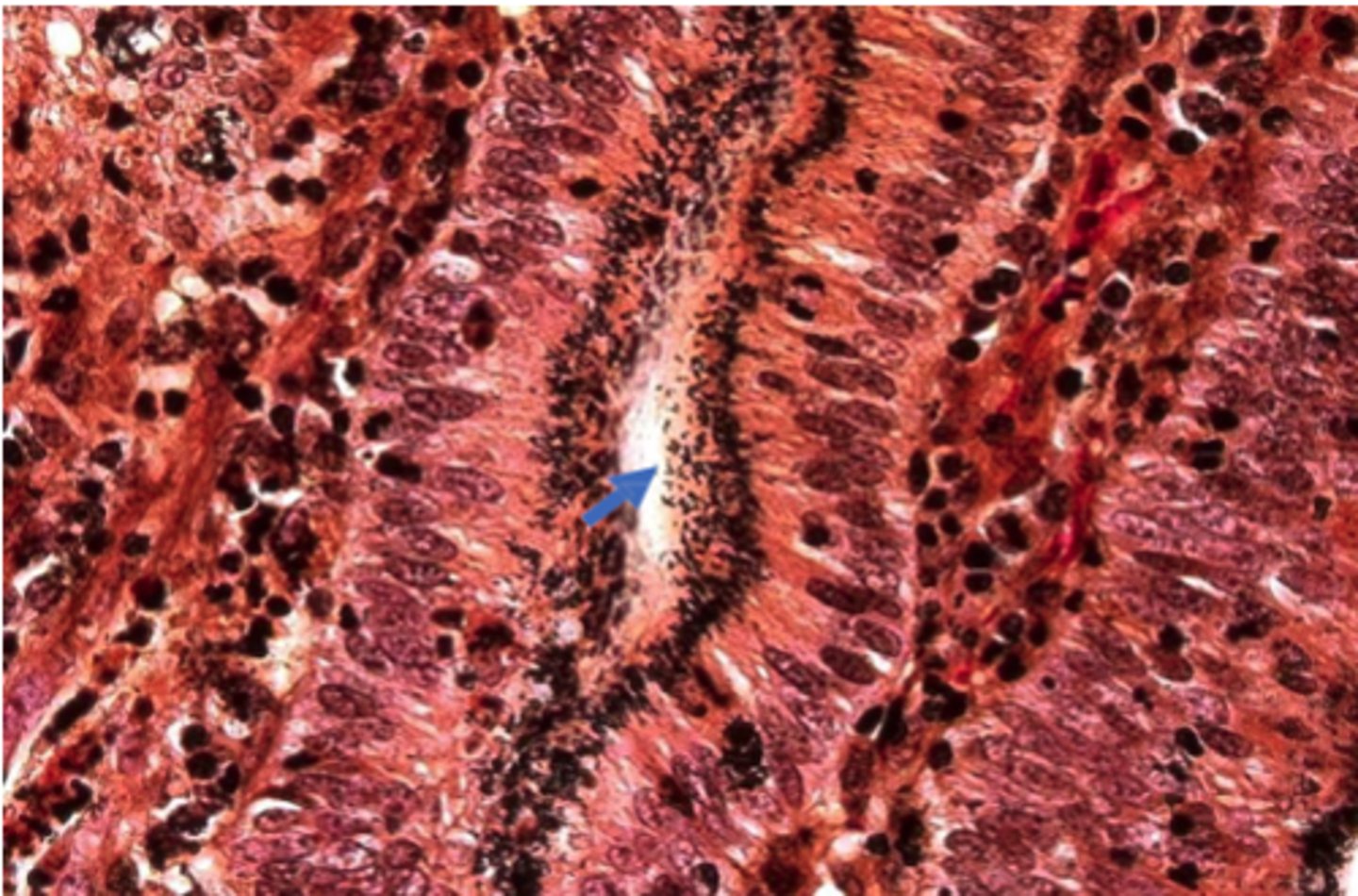 <p>A silver-stained histological section from the ileum of a pig with proliferative intestinal adenomatosis caused by _____________________ This pathogen can’t be grown on normal culture media; enterocyte tissue culture is required. Locate the darkly stained, thin, curved bacteria making up microcolonies within the apical cytoplasm of crypt epithelial cells.</p>