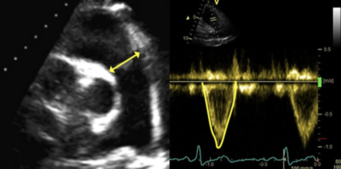 <p>Not validated yet</p><p>Uses stroke volume to calculate RF</p>