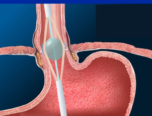 <p>endoscopy, barium swallow studies</p>