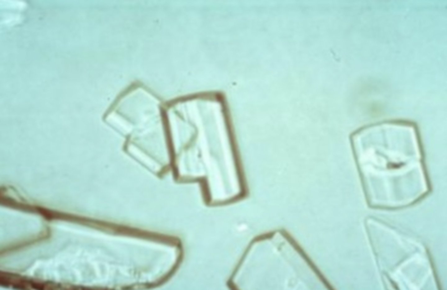 <p>These crystals look like plates of glass, sometimes with a notch out of one corner. Under polarized light, they exhibit a stained glass effect. These crystals are rarely seen unless the specimen has been refrigerated because the lipids remain in droplet form. Large amounts of protein, lipid droplets, fatty casts, or oval fat bodies should be found along with ______ crystals. found in acid or neutral urine.</p>
