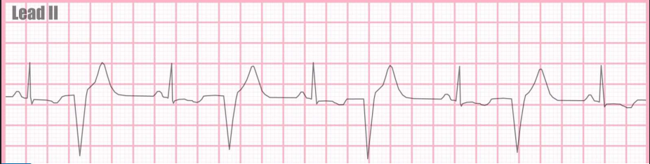 <p><span>a heart rhythm disorder where every other heartbeat is a premature ventricular contraction (PVC) </span></p>
