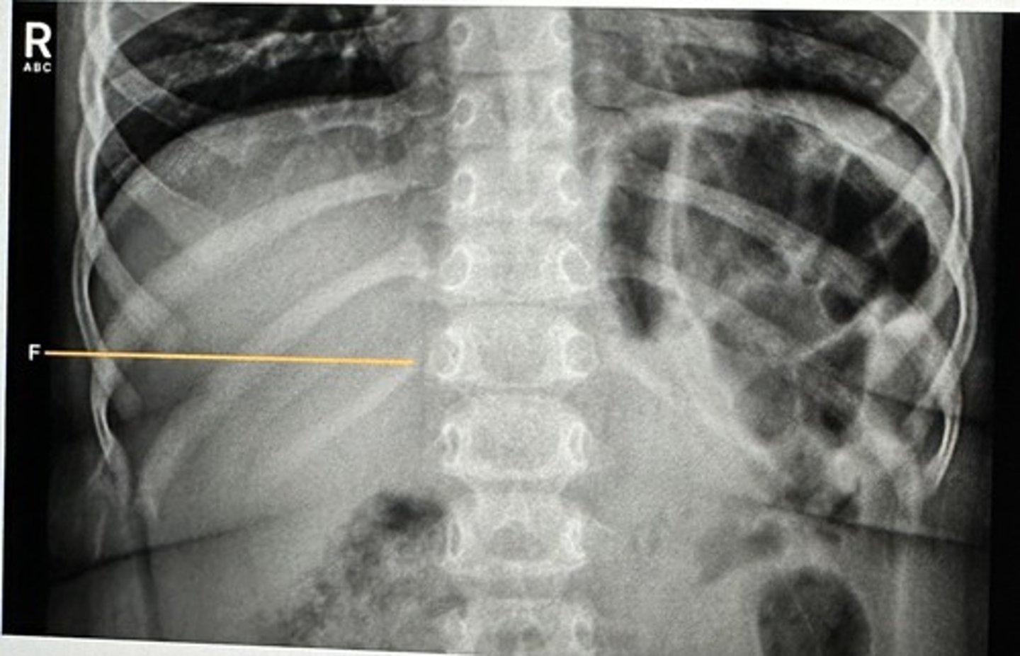 <p>A) Twelfth posterior rib</p>