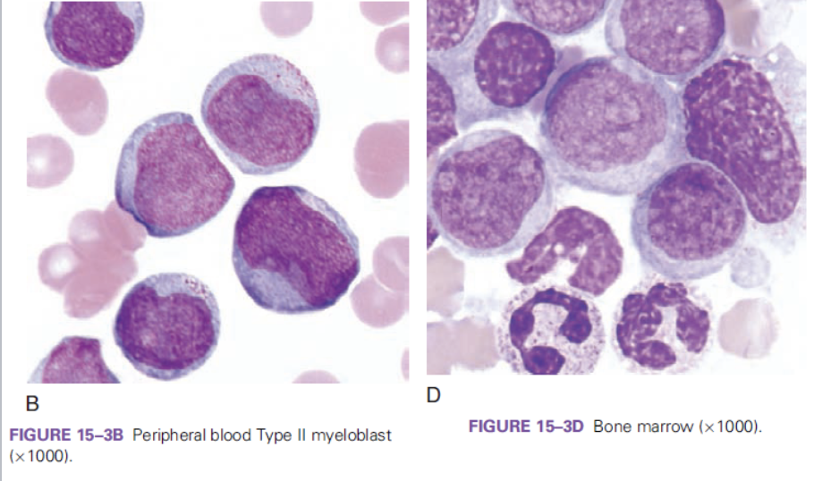 <p>which FAB classification is associated with the following information?</p><ul><li><p>blasts &gt;20% in the BM&nbsp;</p></li><li><p>&gt;10% maturing neutrophil lineage cells&nbsp;</p></li><li><p>&lt;10% of blasts of the monocytic lineage&nbsp;</p></li></ul><p></p>