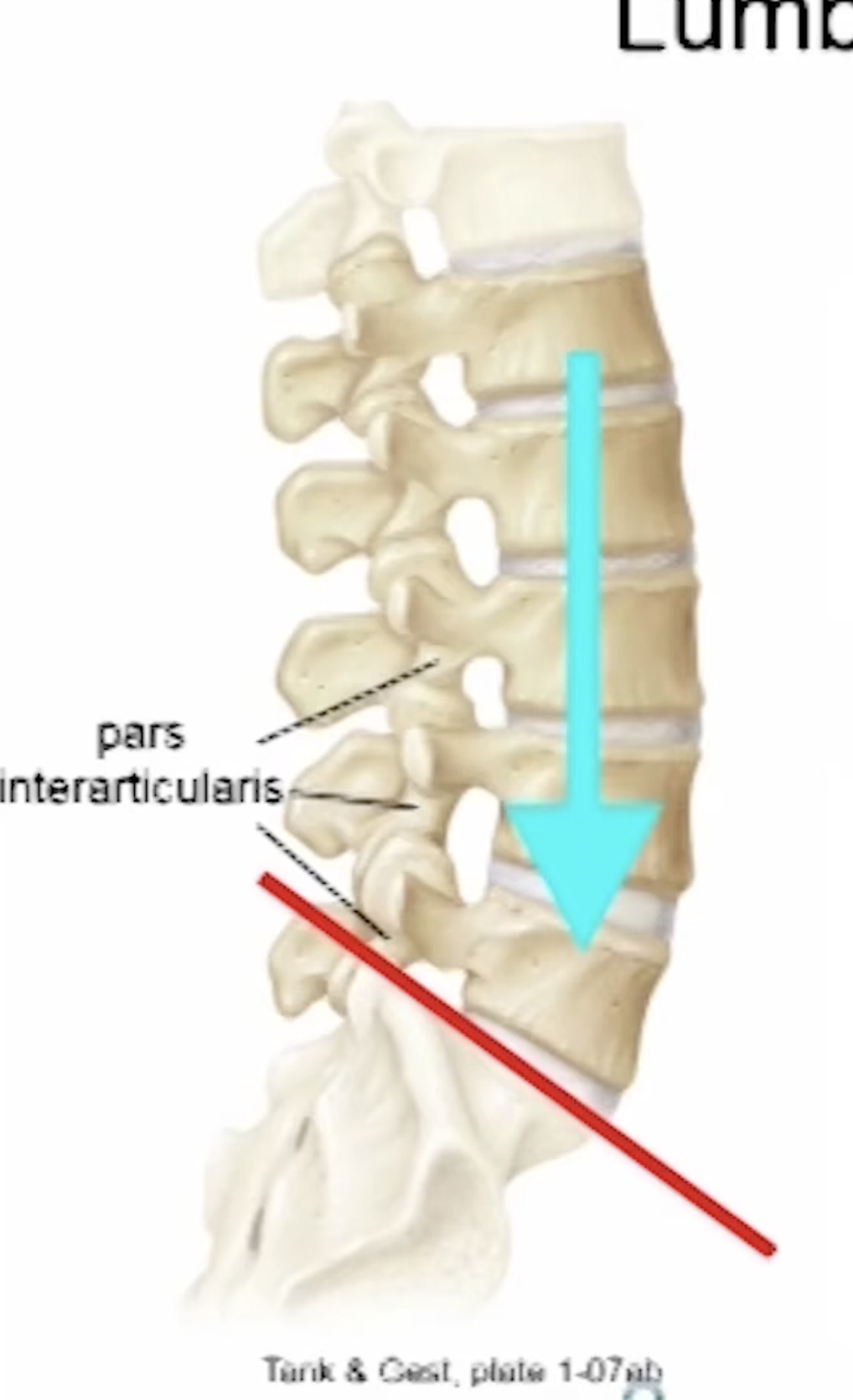 <p>Pars interarticularis. It is located between the superior and inferior articular process on both sides of each vertebrae. Due to the anterior shearing force it’s most commonly the L5 pars interarticularis that is stressed </p>