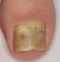 <p><strong>Risk Factors of Onychomycosis</strong></p><p>-Older ____</p><p>-Tinea ______</p><p>-Occlusive footwear</p><p>-Cancer/_________/psoriasis</p><p>-Peripheral vascular disease</p><p>-Cohabitation with others with onychomycosis</p><p>-Immunodeficiency</p><p>-___________</p><p>-History of nail ________</p>