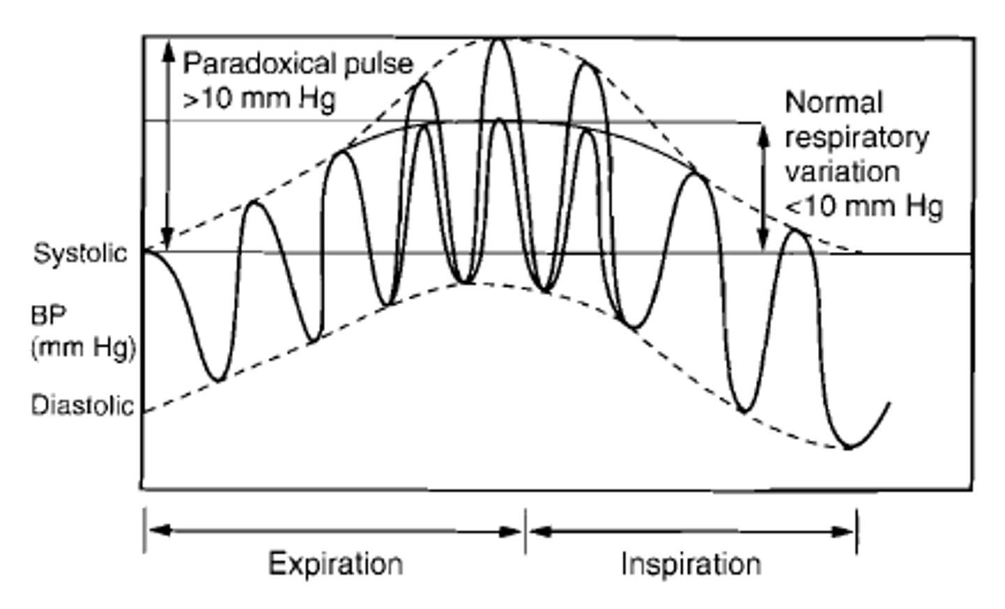 <p>cardiac tamponade→ tx with pericardiocentesis</p>