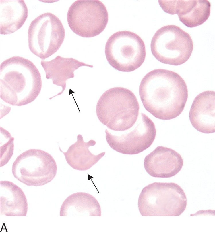 <p>what is an acanthocyte (spur cell)?</p>