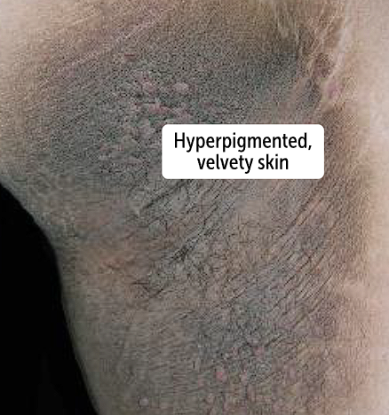 <p>Hyperpigmentation with velvety plaques, usually in the axilla and posterior neck. Has regular borders</p>