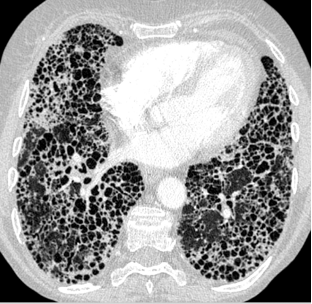 <p><span>-</span><span style="font-family: &quot;Times New Roman&quot;; line-height: normal; font-size: 7pt;">&nbsp;&nbsp;&nbsp;</span><span>Chest X-ray often indistinct can look like a lot of different things, could look like pneumonia, different types of infiltrates could also be normal</span></p><p class="MsoListParagraphCxSpLast"><span>-</span><span style="font-family: &quot;Times New Roman&quot;; line-height: normal; font-size: 7pt;">&nbsp;&nbsp;</span><span>High resolution CT scan: this is the best way to detect ild: will see a reticular pattern, opacities, and honeycombing</span></p>