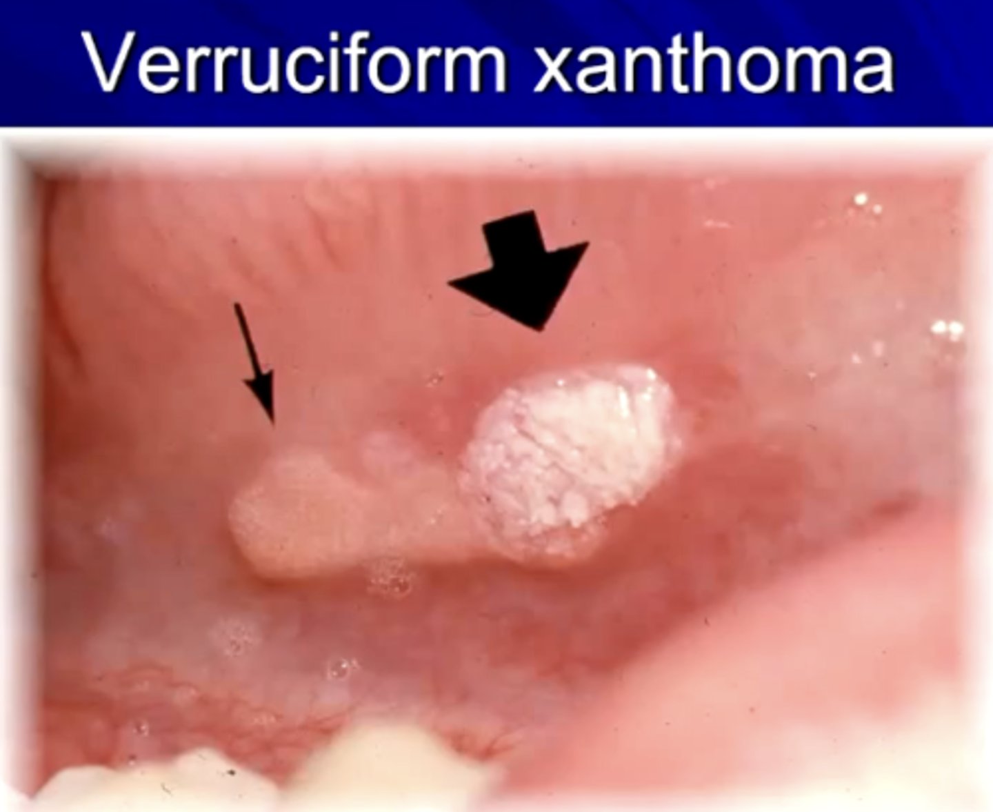<p>a hyperplastic condition of the epithelium with a characteristic accumulation of lipid-laden histiocytes within the CT</p><p>may be due to epithelial trauma </p>