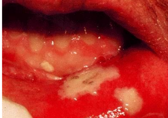 <ol start="3"><li><p>Mucositis/ Stomatitis</p></li></ol><p></p>