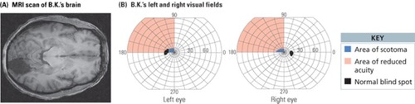 <p>V1 Damage and Scotoma <br>Patient awoke to discover loss of vision in left visual field<br>Vision returned to the lower left visual field, but not the upper left field<br>MRI scan revealed evidence of a stroke in the right occipital lobe<br>Perimetry maps regions of blindness by asking patient to detect a small light moving against a dark background<br>Shortly after the stroke, was unable to detect the light in the area of the stroke, but could report that it had been there after researchers moved the light to a different part of the visual field<br>Over time, some vision returned, but the scotoma remained, and form vision was still poor in the upper left quadrant<br>Knowing something about the visual stimulus, even though the patient says they cannot see it, is called blindsight. This indicates that while there is damage in V1, higher visual areas remain intact.</p>