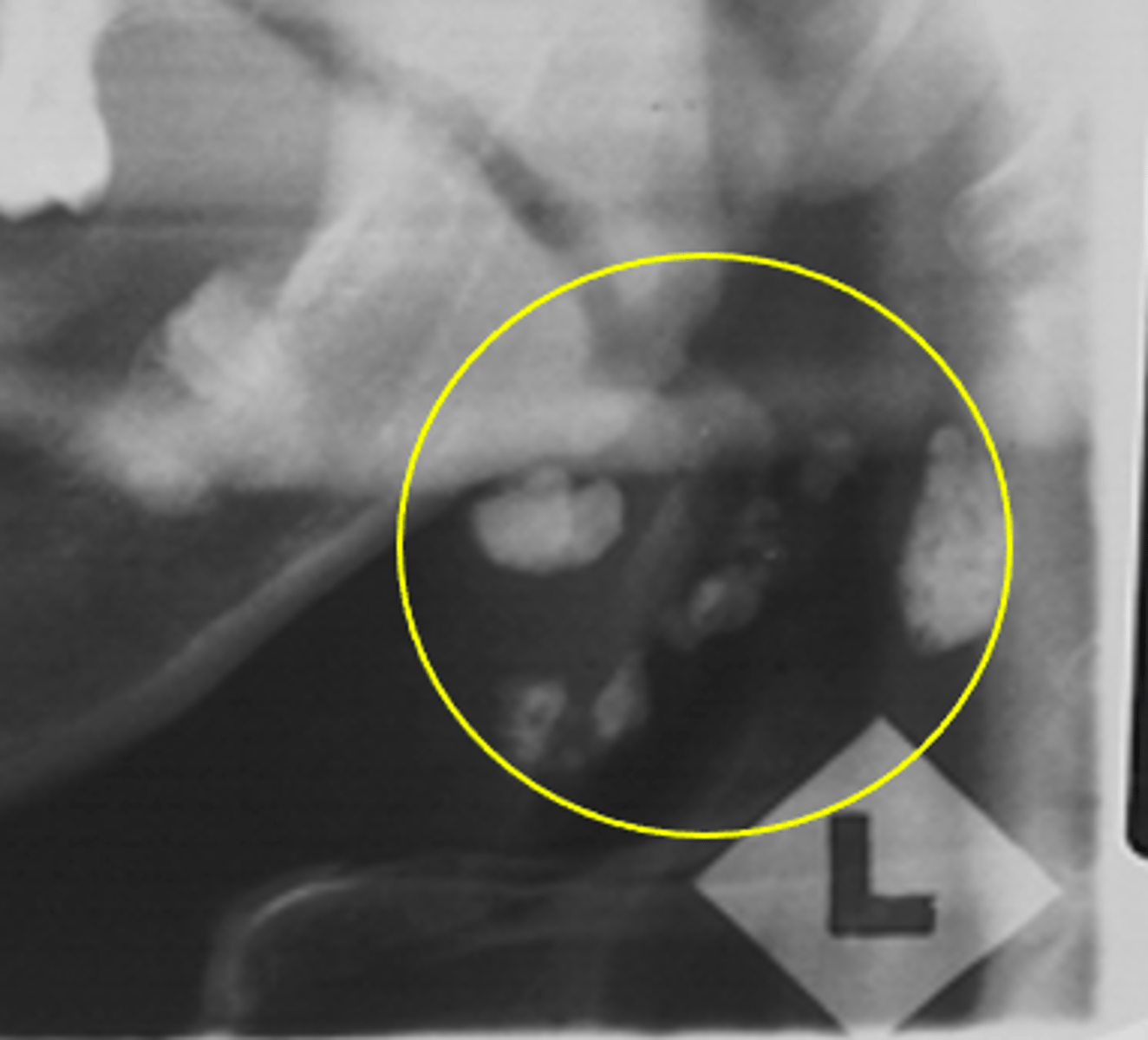 <p>ID the calcified abnormality:</p>