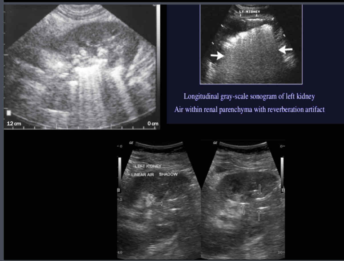 <p>What does the following sonographic appearance describe?</p><p><br><span>1. Multiple echogenic foci with reverberation/comet tail artifact in the sinus</span><br><span>or parenchyma</span><br><span>2.May demonstrate areas of echogenicity with dirty posterior shadowing</span><br><span>3.Gas within parenchyma and/or collecting system</span></p>