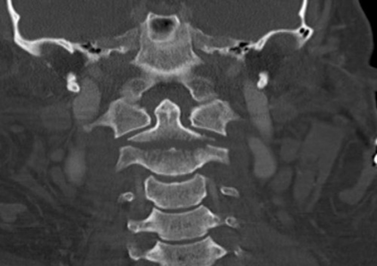 <p>What type of dens fracture is this?</p>
