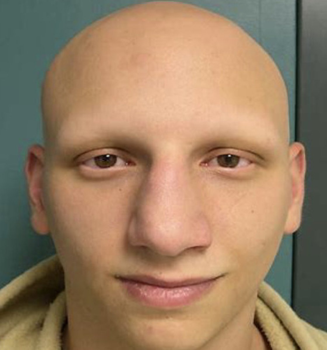 <p>Total loss of terminal body and scalp hair</p>