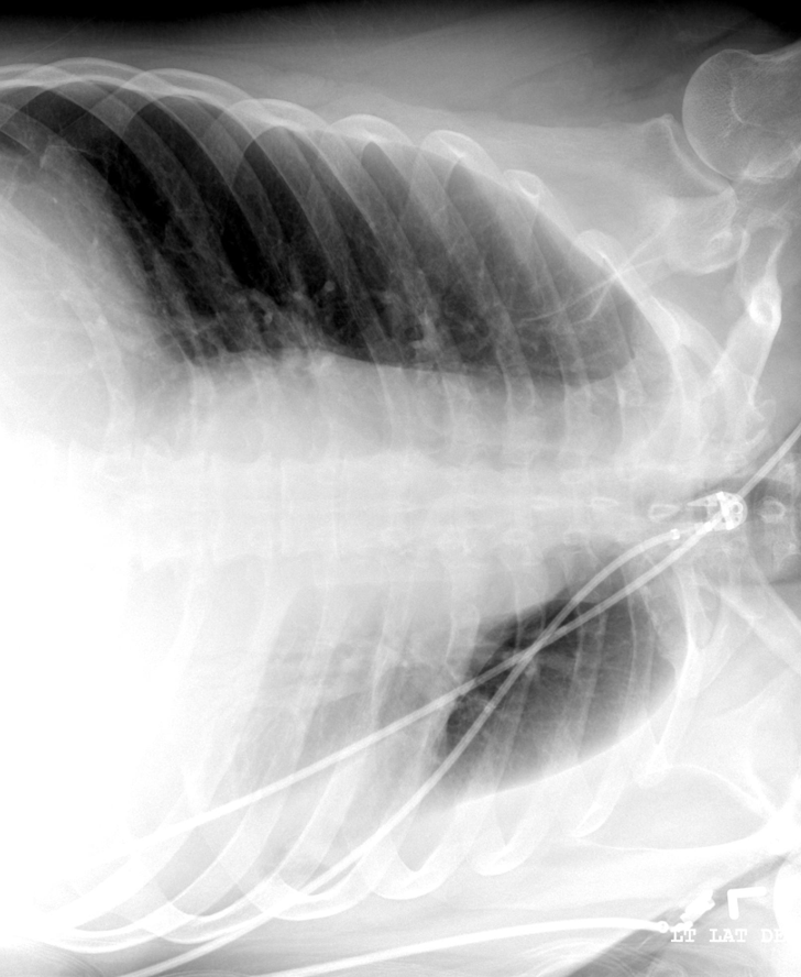 <p>this is a pleural effusion, where is the fluid</p>