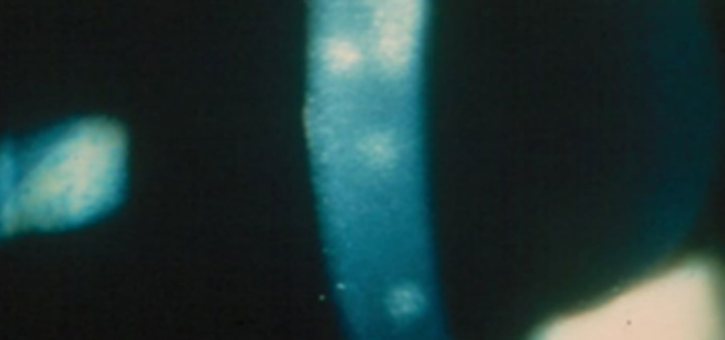 <p>an uncommon, usually bilateral asymmetric idiopathic keratopathy (possibly viral or inflammatory). Most commonly effects females and young adults. Has episodes of exacerbations (1-2 months) and remissions (6 weeks). Appears as coarse punctate epithelial keratitis with little or no hyperemia. Don’t usually present with symptoms, maybe mild discomfort. Treatment includes lubrication and steroids.</p>