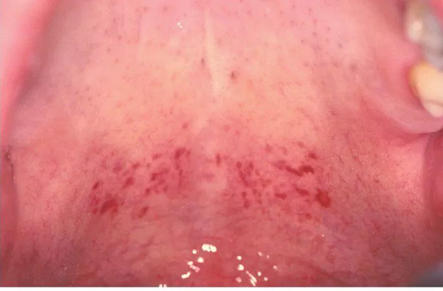 <p>A patient presents with multiple pinpoint red spots (<2 mm) on the soft palate.</p><p>What is the most likely diagnosis?</p>