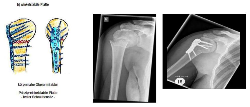 <ul><li><p>mit vielen, zielgerichteten Schrauben Knochen an richtigen Platz bringen</p></li></ul><p></p>