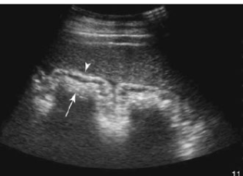 <p>-intestinal thickening</p><p>-liquid GI contents</p><p>-abdominal masses</p><p>-peritoneal effusion</p>
