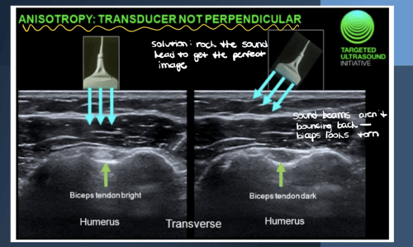 <p>Anisotrophy (i.e., may make a muscle/tendon look torn when it is not)</p>