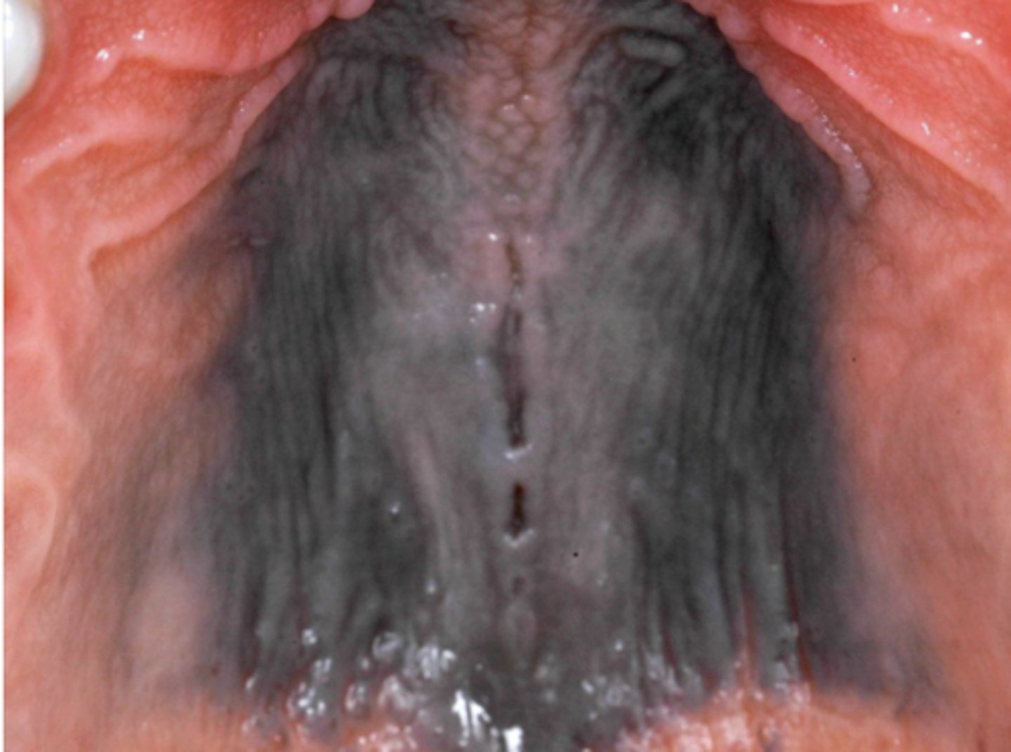 <p>What type of pigmented lesion?</p>