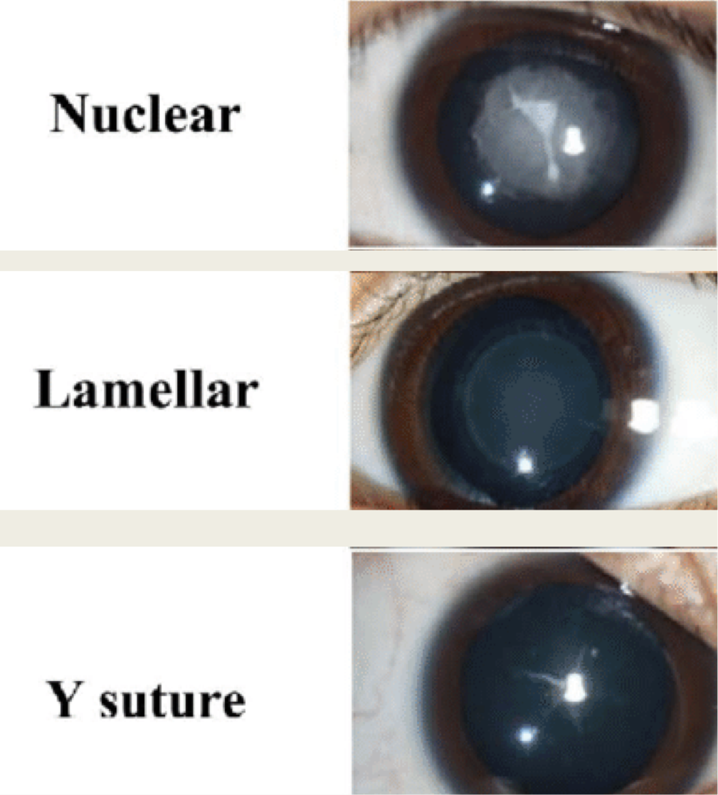 <ul><li><p>affect one zone of lens</p></li><li><p><span><strong><span>Nuclear</span></strong><span>: opacities are confined to the</span><em><span> embryonic or the fetal nucleus</span></em></span></p><ul><li><p><em>dense or fine dust-like</em></p><ul><li><p>dense significantly dec. acuity</p></li></ul></li><li><p><span><span>tend to be </span><em><span>3mm</span></em><span> in size</span></span></p></li><li><p><span><span>bilateral</span></span></p></li><li><p><span><span>assoc. w/ </span><em><span>microcornea</span></em></span></p></li><li><p><span><span>inc risk of developing </span><em><span>glaucoma</span></em><span> after cataract removal</span></span></p></li></ul></li><li><p><span><strong><span>Cortical lamellar opacities:</span></strong><span> most common</span></span></p><ul><li><p><em>discrete</em> and <em>round</em> shape</p></li><li><p><span><span>Will affect one or more of the rings in the developing cortex</span></span></p><ul><li><p><span><span>Nucleus will be relatively clear</span></span></p></li></ul></li><li><p><span><em><span>5 mm or larger</span></em><span> in diameter</span></span></p></li><li><p><span><span>Radial extensions or riders</span></span></p></li><li><p><span><span>Affect on vision is variable</span></span></p></li></ul></li><li><p><span><strong><span>Sutural</span></strong><span>: lenticular opacity following anterior or posterior Y suture</span></span></p><ul><li><p><em>slow</em> progression</p></li><li><p>minimum affect on VA</p></li></ul></li><li><p><span><strong><span>Cerulean (blue dot):</span></strong></span></p><ul><li><p><span><span>Numerous small </span><em><span>blue</span></em><span> opacities in </span><em><span>cortex</span></em><span> and </span><em><span>nucleus</span></em></span></p></li><li><p><span><span>typically non-progressive</span></span></p></li><li><p><span><span>minimum affect on VA</span></span></p></li></ul></li></ul><p></p>