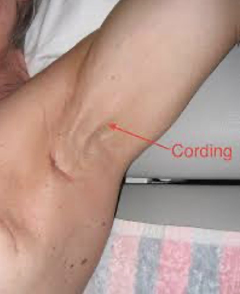 <p>after node removal, scarring of lymphatic system, pain, tightness</p>